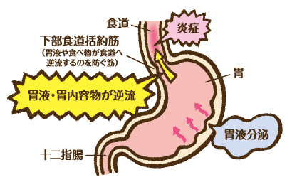 食道炎 ： 逆流性食道炎の症状