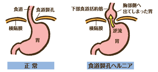 ヘルニア トレ 筋 裂孔 食道 Q&A 食道裂孔ヘルニアは治らない？対策について